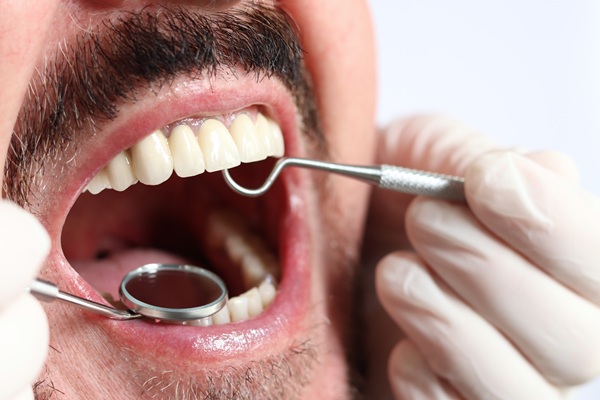 Treatment Options For A Chipped Tooth By A Cosmetic Dentist