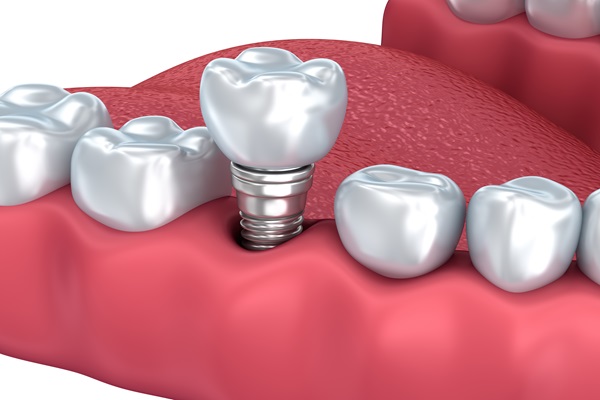 When To Choose Dental Implants Over Dentures