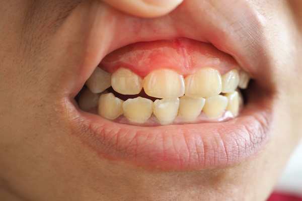 How A Family Dentist Checks For Gum Disease At A Dental Check Up