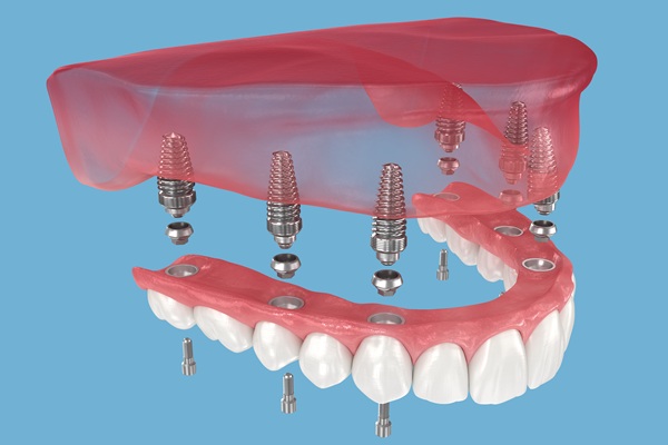 Implant Supported Dentures Guide: Process, Benefits, And Care