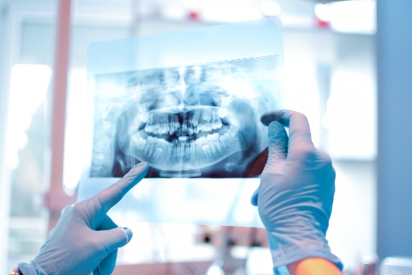 Questions About Digital X Rays