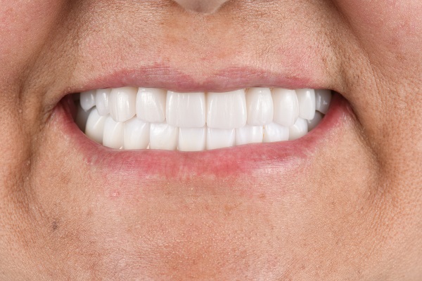 Veneers To Fix Tooth Imperfections